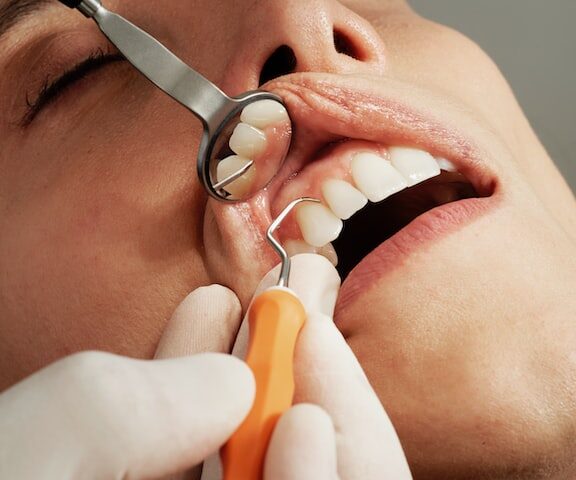 Advantages of Treating a Root Canal